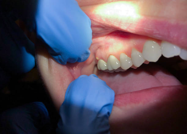 Best Emergency Dental Care for Abscessed Tooth in Kirkl, IN