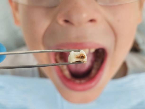 Best Emergency Dentist for Knocked-Out Tooth in Kirkl, IN